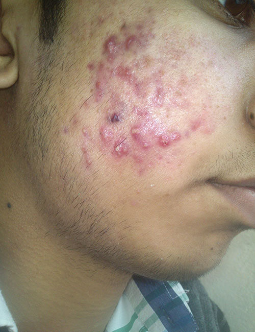 Acne and Blemishes-02
