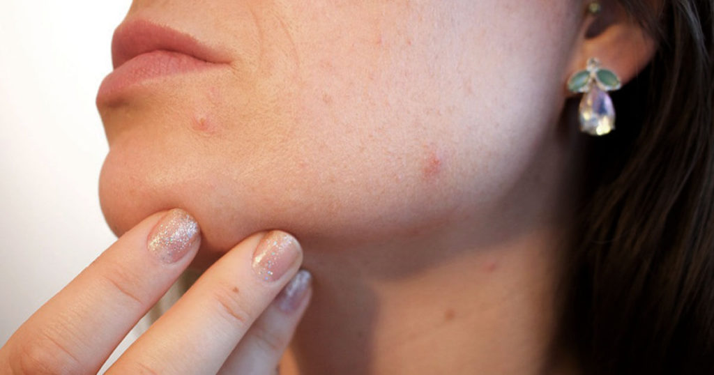 Acne and Blemishes